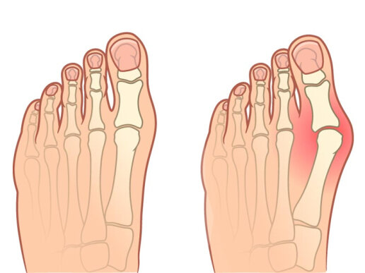 Що болить при вальгусі?