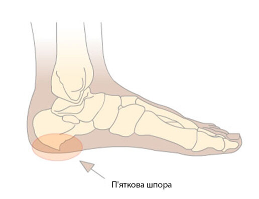 Як зрозуміти п'яткова шпора чи ні?