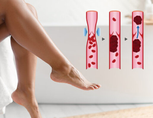 Як компресійні панчохи можуть запобігти тромбозу?